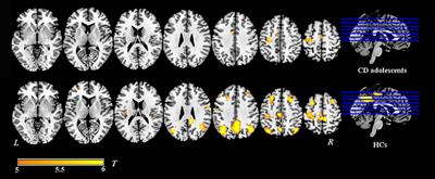 Temporoparietal Junction Hypoactivity during Pain-Related Empathy Processing in Adolescents with Conduct Disorder